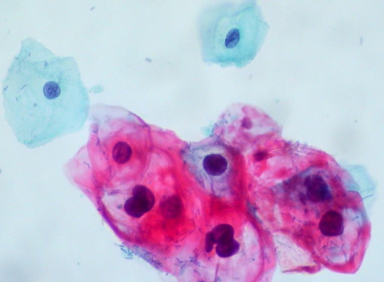 The color of HPV: The blue cells are normal. The red cells are infected with the virus.