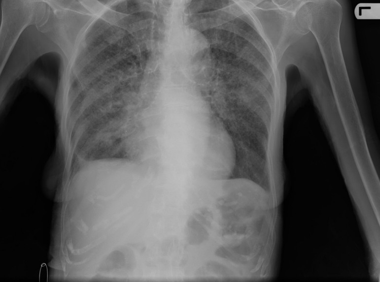 A TB patient's X-ray.